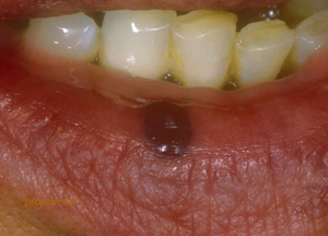 hemangioma dental en el labio inferior