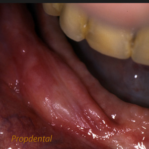 tratamiento epulis dental barcelona