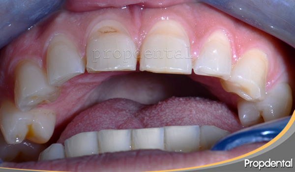Preguntas frecuentes sobre bruxismo dental