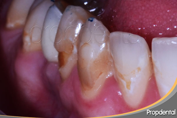 desgaste del esmalte en el cuello del diente