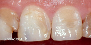desgaste de los dientes por erosión dental