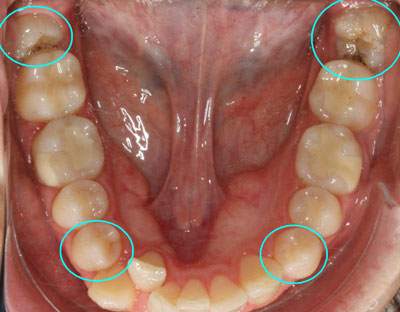 indicación de las extracciones en ortodoncia