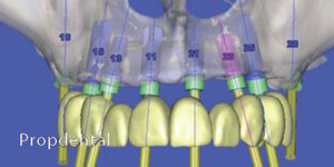 importancia del escáner dental previo a una cirugía de implantes dentales