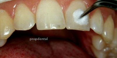 tratamiento de la pulpitis reversible