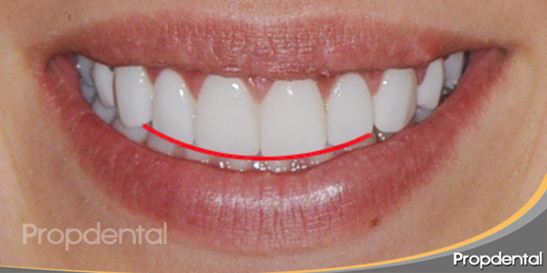 Paralelismo de la curvatura incisal de los dientes anterosuperiores con el labio inferior