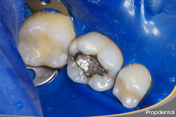 remoción segura del amalgama de plata por dentista holístico en Barcelona