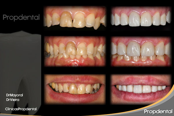 análisis dental para la estética dental de las prótesis dentales