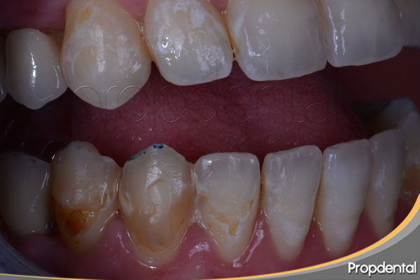 desmineralización del esmalte dental por bulimia