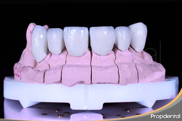 dientes maxilares en prótesis dentales