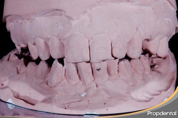 modelos de yeso usado para el diagnóstico en odontología