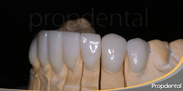 prótesis estéticas dentales