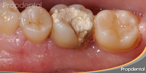 cicatrización después del alargamiento de corona por el periodoncista