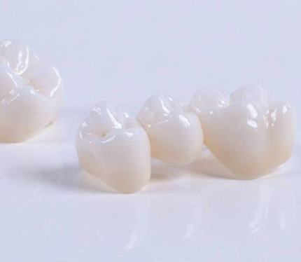 póntico prótesis dentales