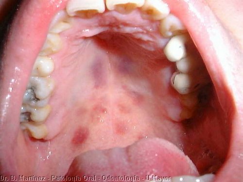 Mouth Herpes – Pictures, Symptoms and Treatment