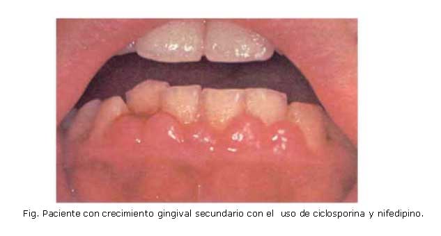 agrandamiento gingival por ciclosporina