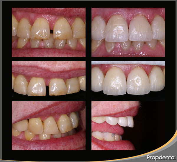 caso clínico de estética dental para cerrar el espacio entre los dientes