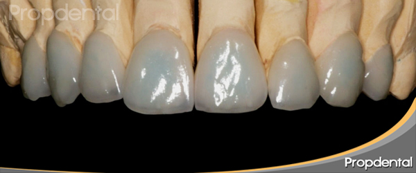 veneers propdental dental porcelain carillas own tooth porcelana es structure smile precio dentales dientes achieve removal perfect very artículo