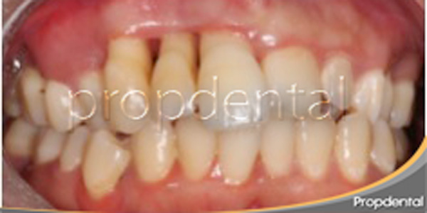 periodontitis e implantes dentales