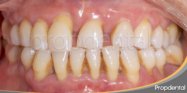 colocación de implantes con periodontitis