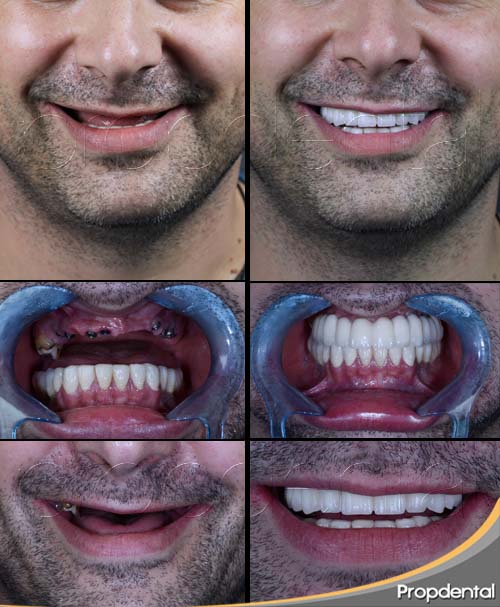 Preguntas sobre implantes dentales