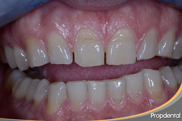 Bruxismo Como Tratar El Apretamiento Y Rechinar De Los Dientes