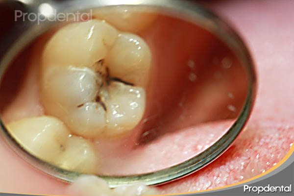 caries dental en una muela