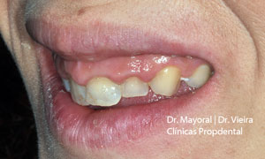 dientes antes tratamiento