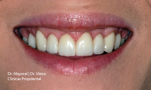 carillas dentales