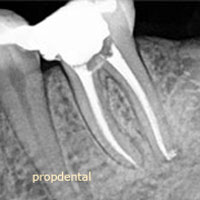 reendodoncia por endodoncista