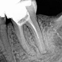 endodoncia mal hecha