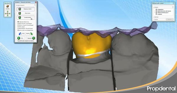 fabricación de prótesis con cadcam dental