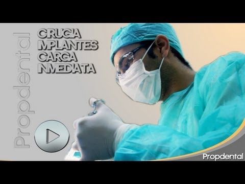 vídeo de la colocación de implantes tras la extracción