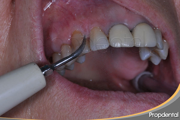 limpieza dental con ultrasonidos