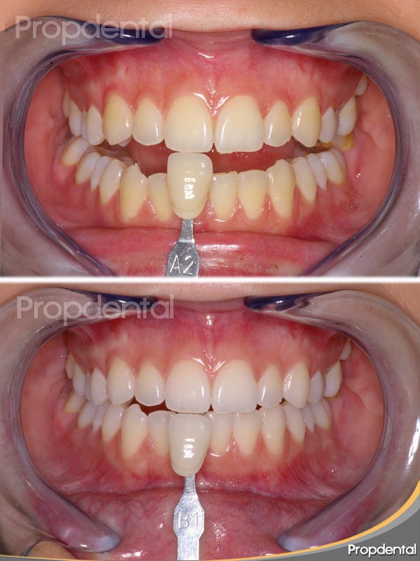 blanqueamiento dental casero