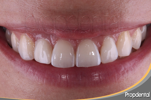 reposición diente perdido con implante dental en Barcelona