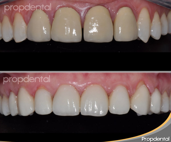 Diferencias entre las coronas de zirconio y de 100% porcelana