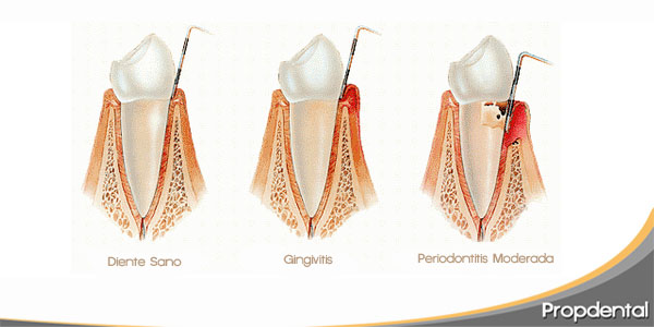 tratar la periodontitis