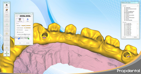 cadcam de una rehabilitación de prótesis de circonio sobre implantes dentales