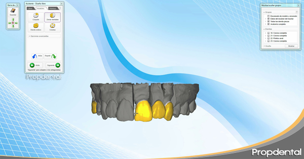 diseño de coronas cad cam dental