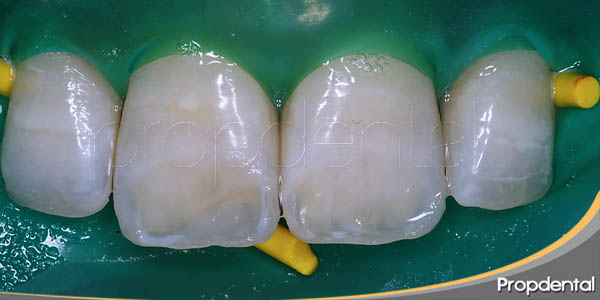 microabrasión dental