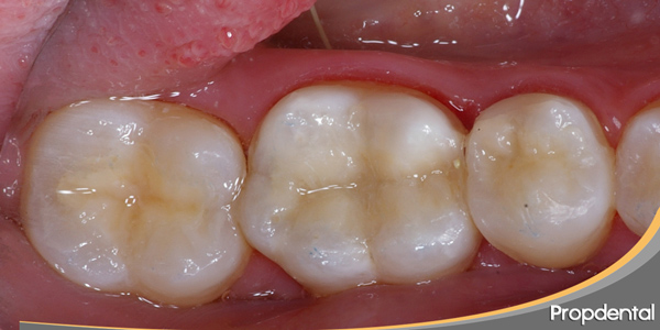 precio reconstrucción de composite dental