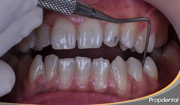 Sangrado al sondaje periodontal