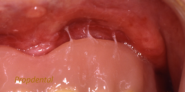 épulis dental