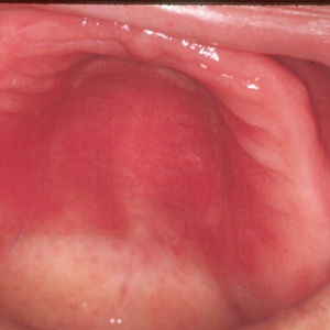 estomatitis protesica candida albicans