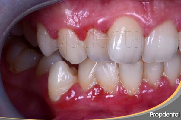 gingivitis asociada a placa bacteriana