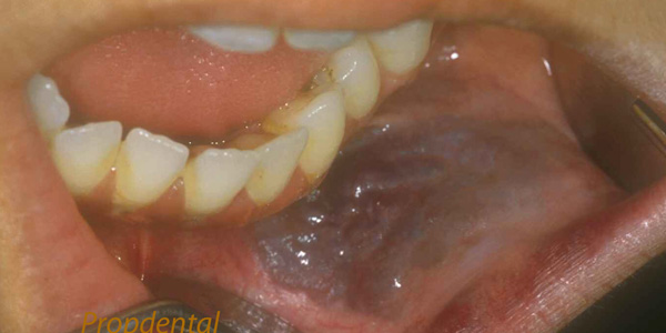 hemangioma dental