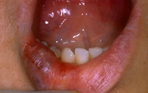 hemangioma odontologia