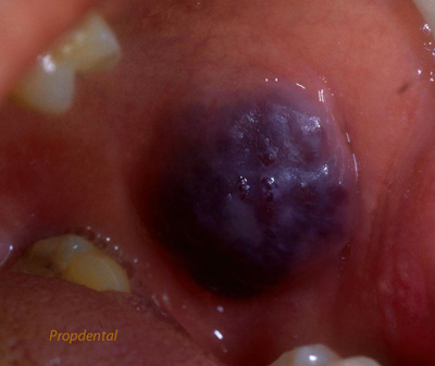 hemangioma mucosa de la boca