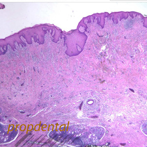 examen de histologia del epulis dental