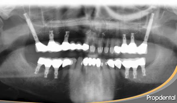 implantes en zona posterior sin hueso en Barcelona y Madrid colocados en Propdental